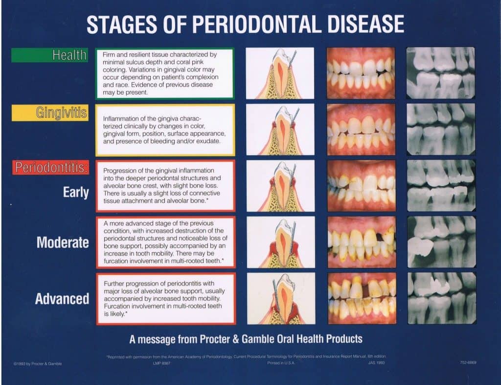 Stages of Peridontal Disease